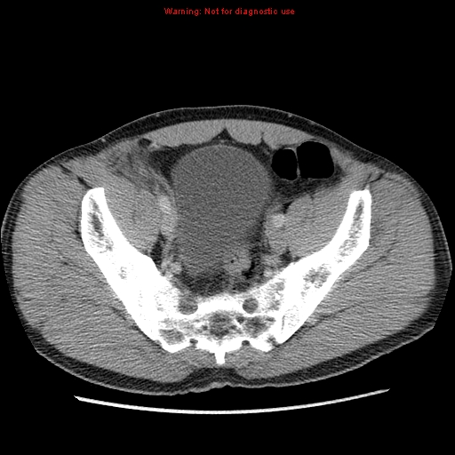 File:Appendicitis and renal cell carcinoma (Radiopaedia 17063-16760 A 47).jpg