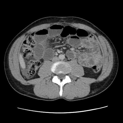 File:Appendicitis complicated by post-operative collection (Radiopaedia 35595-37114 A 46).jpg
