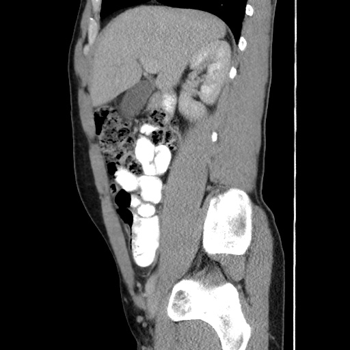 Appendicitis complicated by post-operative collection (Radiopaedia 35595-37114 C 27).jpg