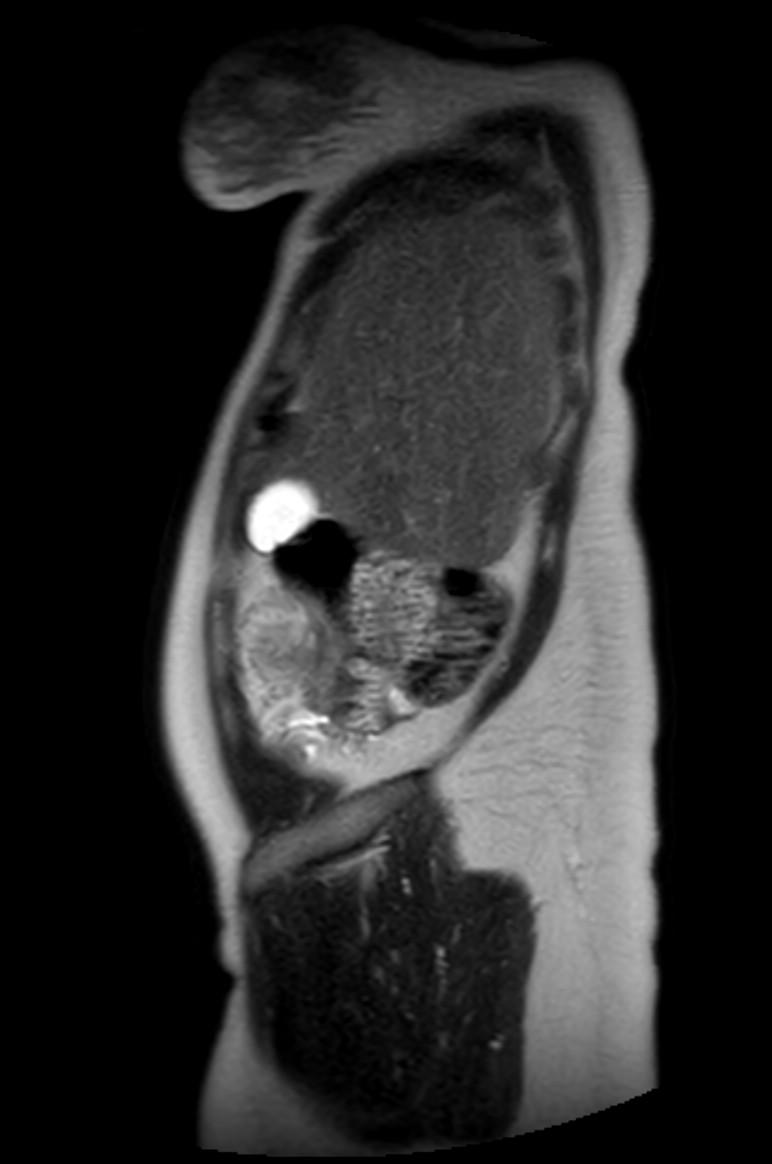 Appendicitis in gravida (MRI) (Radiopaedia 89433-106395 Sagittal T2 57).jpg