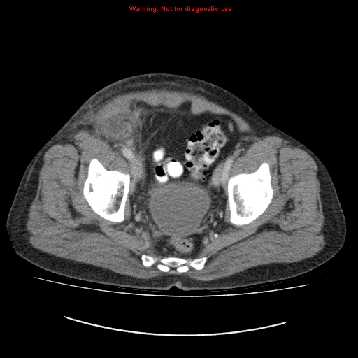 File:Appendicitis mass in inguinal hernia (Radiopaedia 26858-27029 A 21).jpg