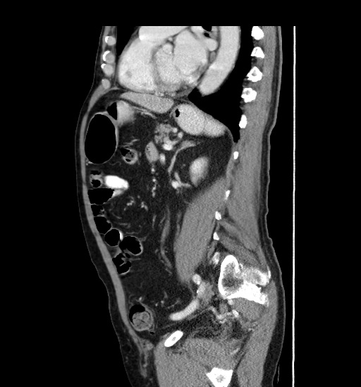 Appendicitis with localized perforation and abscess formation (Radiopaedia 49035-54130 C 40).jpg