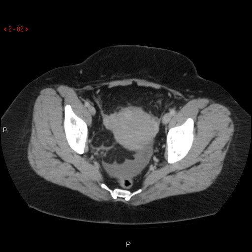 Appendicitis with microperforation- promontoric type (Radiopaedia 27268-27442 C 70).jpg