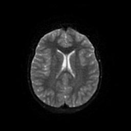 Arachnoid cyst - middle cranial fossa (Radiopaedia 67671-77088 Axial DWI 44).jpg