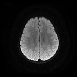File:Arachnoid cyst - middle cranial fossa (Radiopaedia 86780-102938 Axial DWI 10).jpg