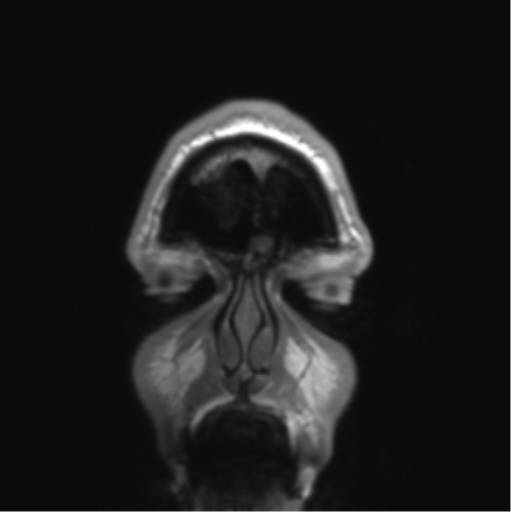 Arachnoid cyst with subdural hematoma (Radiopaedia 85892-101743 Coronal T1 90).png