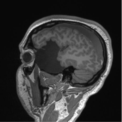 Arachnoid cyst with subdural hematoma (Radiopaedia 85892-101743 Sagittal T1 25).png