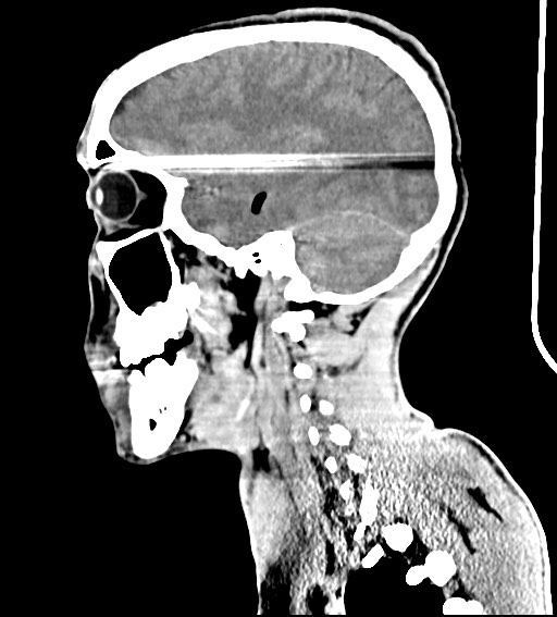 Arrow injury to the brain (Radiopaedia 72101-82607 H 24).jpg