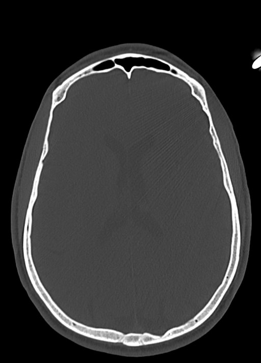 Arrow injury to the head (Radiopaedia 75266-86388 Axial bone window 80).jpg