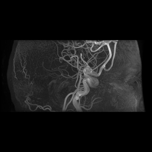 Arteriovenous malformation (Radiopaedia 71628-81999 Axial MRA 20).jpg