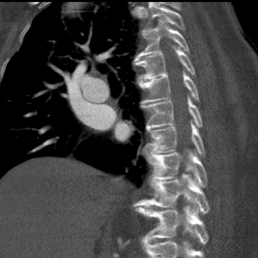 File:Ascending aortic aneurysm (Radiopaedia 20913-20846 A 29).jpg