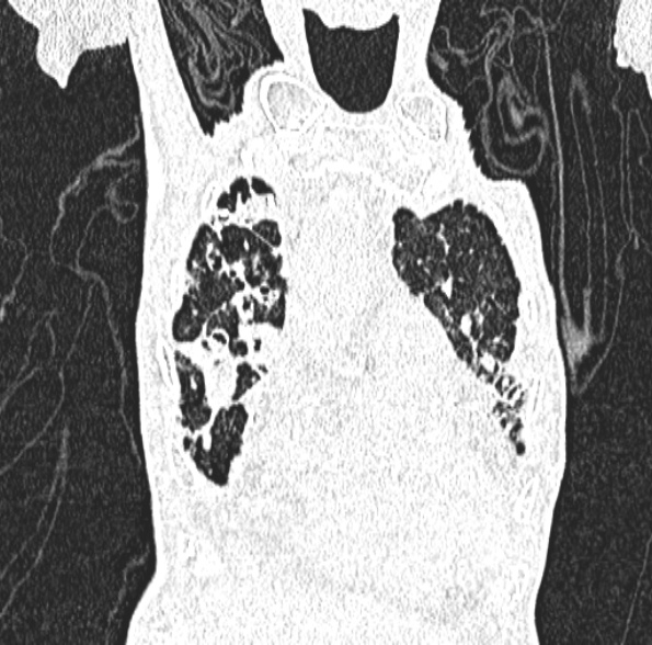 Aspergilloma- with Monod sign (Radiopaedia 44737-48532 Coronal lung window 148).jpg