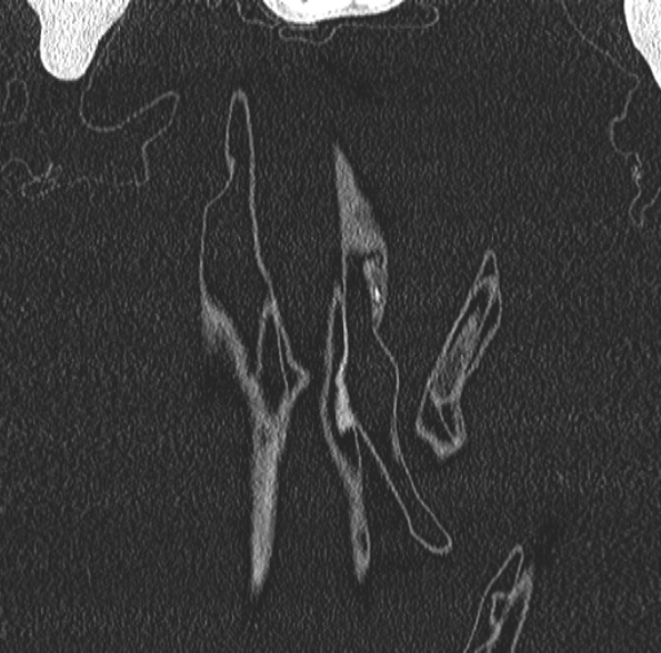 Aspergilloma- with Monod sign (Radiopaedia 44737-48532 Coronal lung window 66).jpg