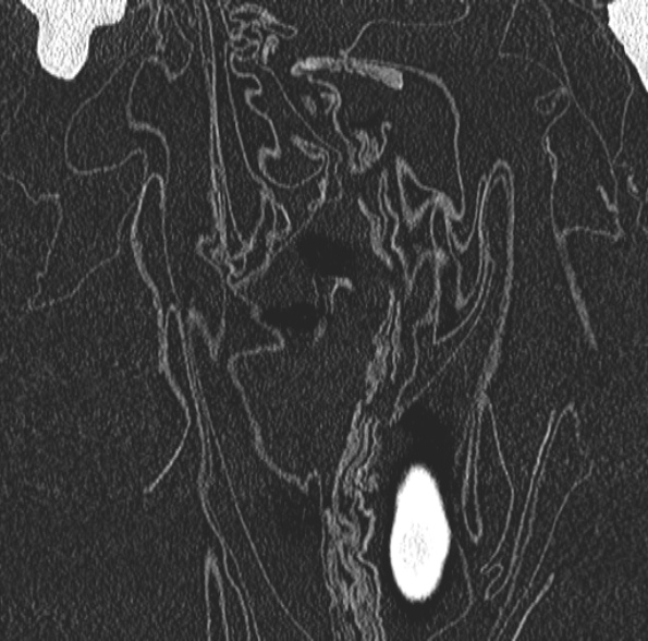 Aspergilloma- with Monod sign (Radiopaedia 44737-48532 Coronal lung window 97).jpg