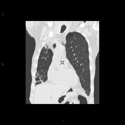 File:Aspergilloma (Radiopaedia 14842-14787 Coronal lung window 11).jpg