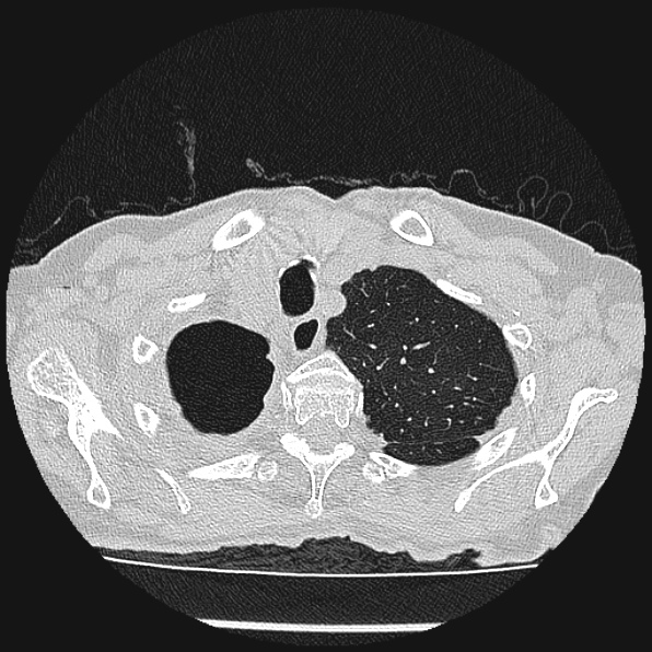 Aspergilloma (Radiopaedia 24458-24763 Axial lung window 9).jpg