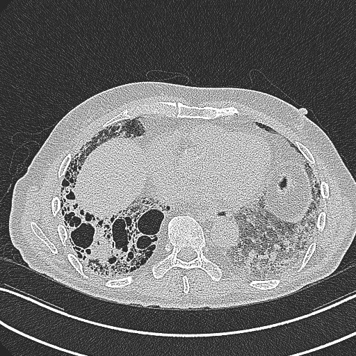 File:Aspergilloma on background pulmonary fibrosis (Radiopaedia 60942-68757 B 36).jpg