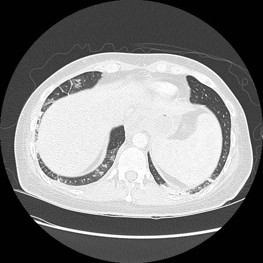 Aspiration pneumonia secondary to laparoscopic banding (Radiopaedia 18345-18183 lung window 94).jpg