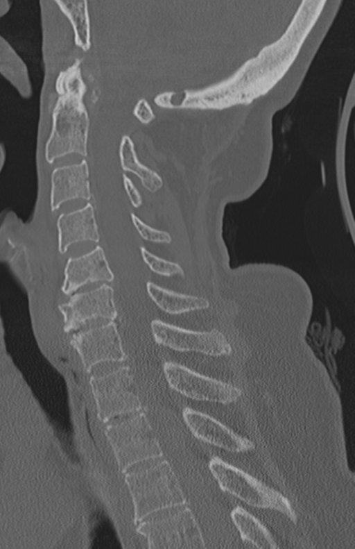 Atlanto-axial subluxation (Radiopaedia 36610-38176 Sagittal bone window 43).png