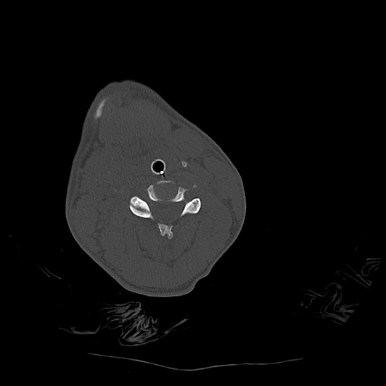 Atlanto-occipital dissociation (Traynelis type 1), C2 teardrop fracture, C6-7 facet joint dislocation (Radiopaedia 87655-104061 Axial bone window 46).jpg