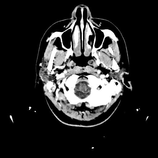 Atretic cephalocele (Radiopaedia 89782-106881 Axial with contrast 16).jpg
