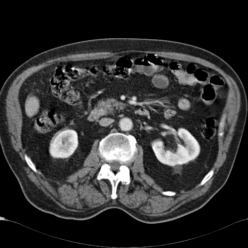 Atypical hepatocellular carcinoma (Radiopaedia 41744-44698 B 47).jpg