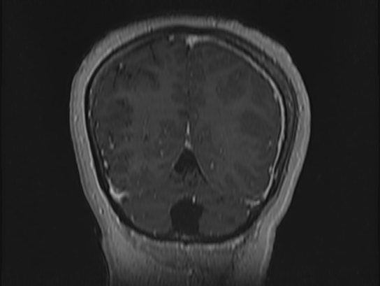 Atypical meningioma (Radiopaedia 62985-71406 Coronal T1 C+ 105).jpg