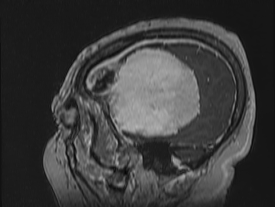 Atypical meningioma (Radiopaedia 62985-71406 Sagittal T1 C+ 83).jpg
