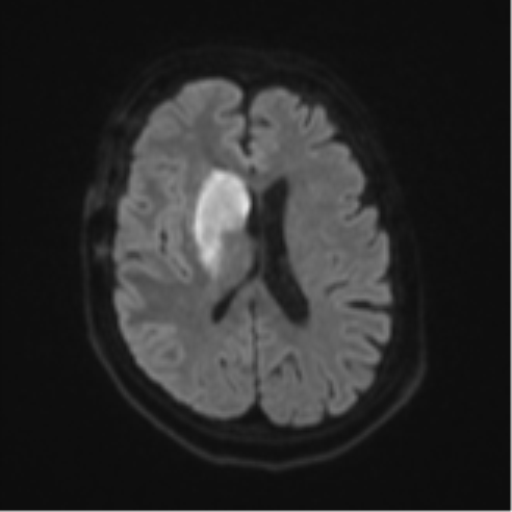 File:Atypical meningioma (WHO Grade II) (Radiopaedia 54742-60981 Axial DWI 45).png