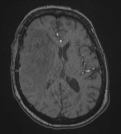 Atypical meningioma (WHO Grade II) (Radiopaedia 54742-60981 Axial MRA 56).png