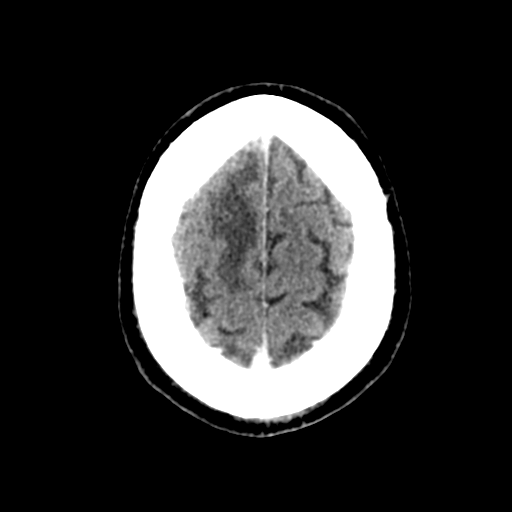 File:Atypical meningioma (WHO grade II) with brain invasion (Radiopaedia 57767-64728 Axial C+ 9).png