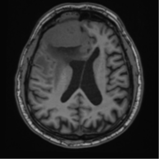 File:Atypical meningioma (WHO grade II) with brain invasion (Radiopaedia 57767-64729 Axial T1 30).png