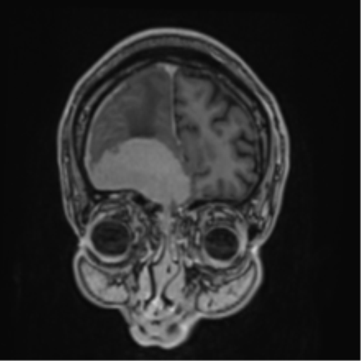 File:Atypical meningioma (WHO grade II) with brain invasion (Radiopaedia 57767-64729 Coronal T1 C+ 12).png