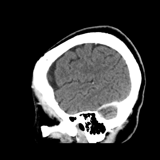 Atypical meningioma (WHO grade II) with osseous invasion (Radiopaedia 53654-59715 G 45).png