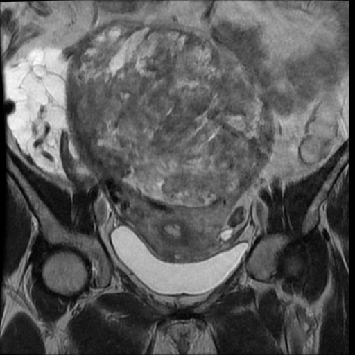 File:Atypical retroperitoneal lymphocoeles with large leiomyoma of uterus (Radiopaedia 32084-33027 Coronal T2 16).jpg