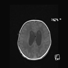 Atypical teratoid rhabdoid tumor (prenatal US and neonatal MRI) (Radiopaedia 59091-66388 Axial T1 41).jpg