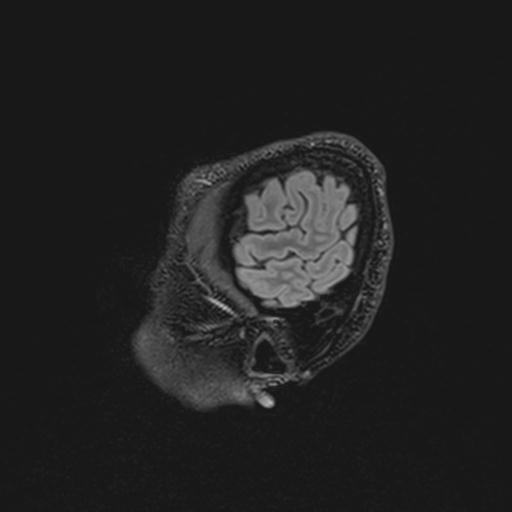 Autoimmune limbic encephalitis (Radiopaedia 30363-31005 Sagittal FLAIR 21).jpg