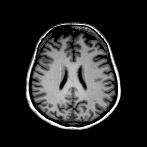 Autoimmune limbic encephalitis (Radiopaedia 30363-31005 T1 Axial 1mm 97).jpg