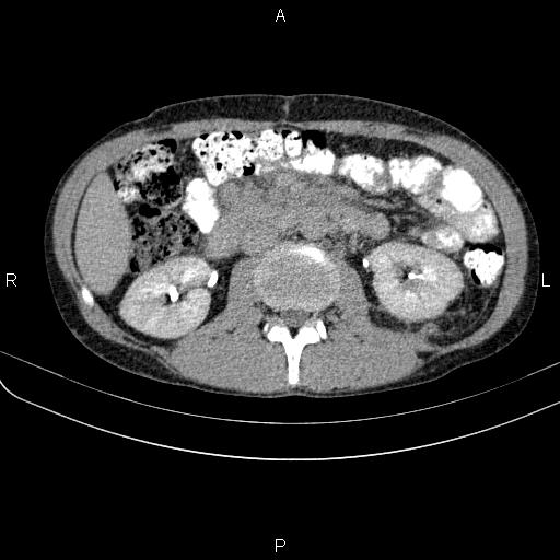 Autoimmune pancreatitis (Radiopaedia 84925-100431 Axial C+ delayed 36).jpg