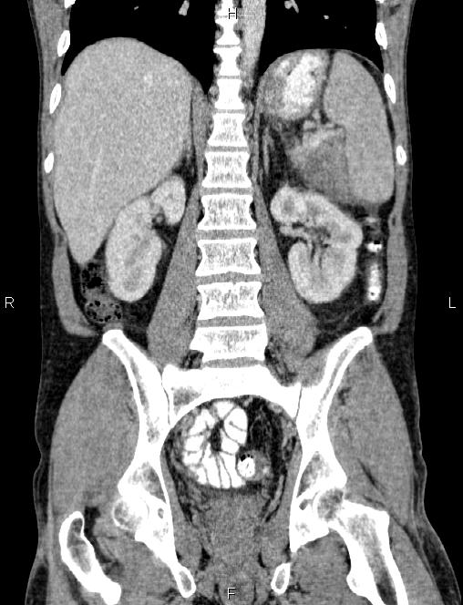 Autoimmune pancreatitis (Radiopaedia 84925-100431 D 39).jpg