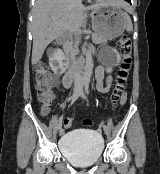 Autosomal dominant polycystic kidney disease (Radiopaedia 38189-40194 Coronal C+ delayed 38).jpg