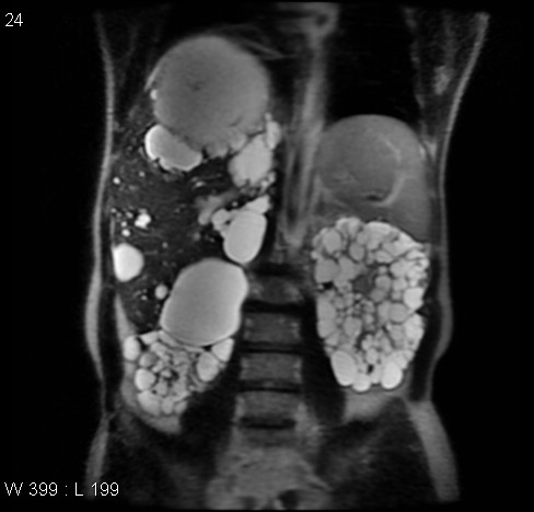 File:Autosomal dominant polycystic kidney disease (Radiopaedia 5202-6969 Coronal T2 9).jpg