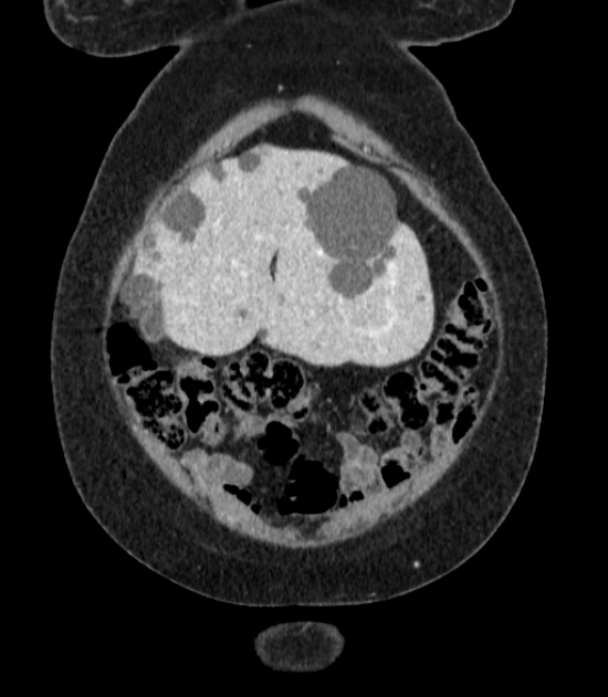 Autosomal dominant polycystic kidney disease (Radiopaedia 57124-64017 B 10).jpg