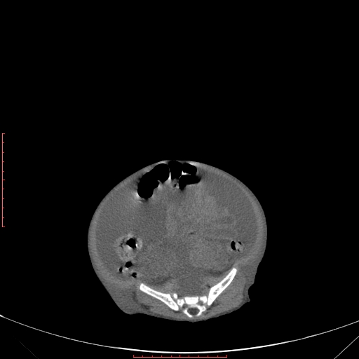 Autosomal recessive polycystic kidney disease associated with Caroli disease (Radiopaedia 61932-69984 Axial non-contrast 291).jpg