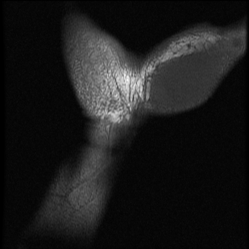 File:Avascular necrosis - scaphoid non-union (Radiopaedia 63457-72065 Coronal T1 2).jpg