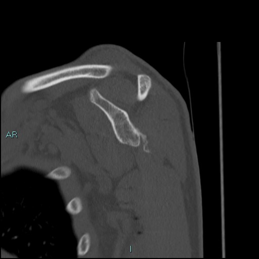 Avascular necrosis after fracture dislocations of the proximal humerus (Radiopaedia 88078-104653 Sagittal bone window 41).jpg