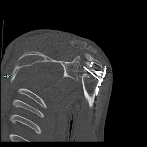 Avascular necrosis after fracture dislocations of the proximal humerus (Radiopaedia 88078-104655 Coronal bone window 78).jpg