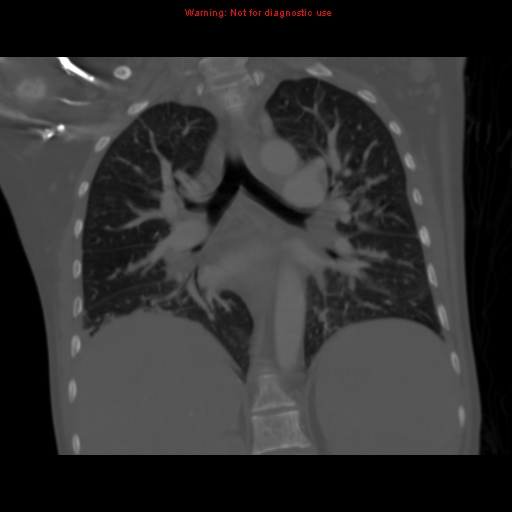 File:Avascular necrosis in sickle cell disease (Radiopaedia 17448-17152 Coronal bone window 75).jpg
