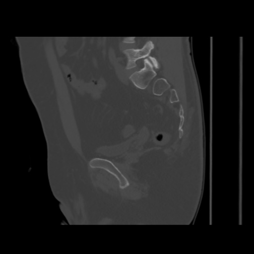 File:Avascular necrosis of the hip (Radiopaedia 61503-69467 B 35).jpg