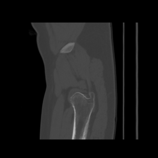 File:Avascular necrosis of the hip (Radiopaedia 61503-69467 B 56).jpg